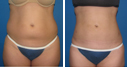 Before & After Photos